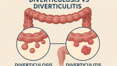 Diverticulitis