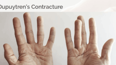 Dupuytren's Contracture