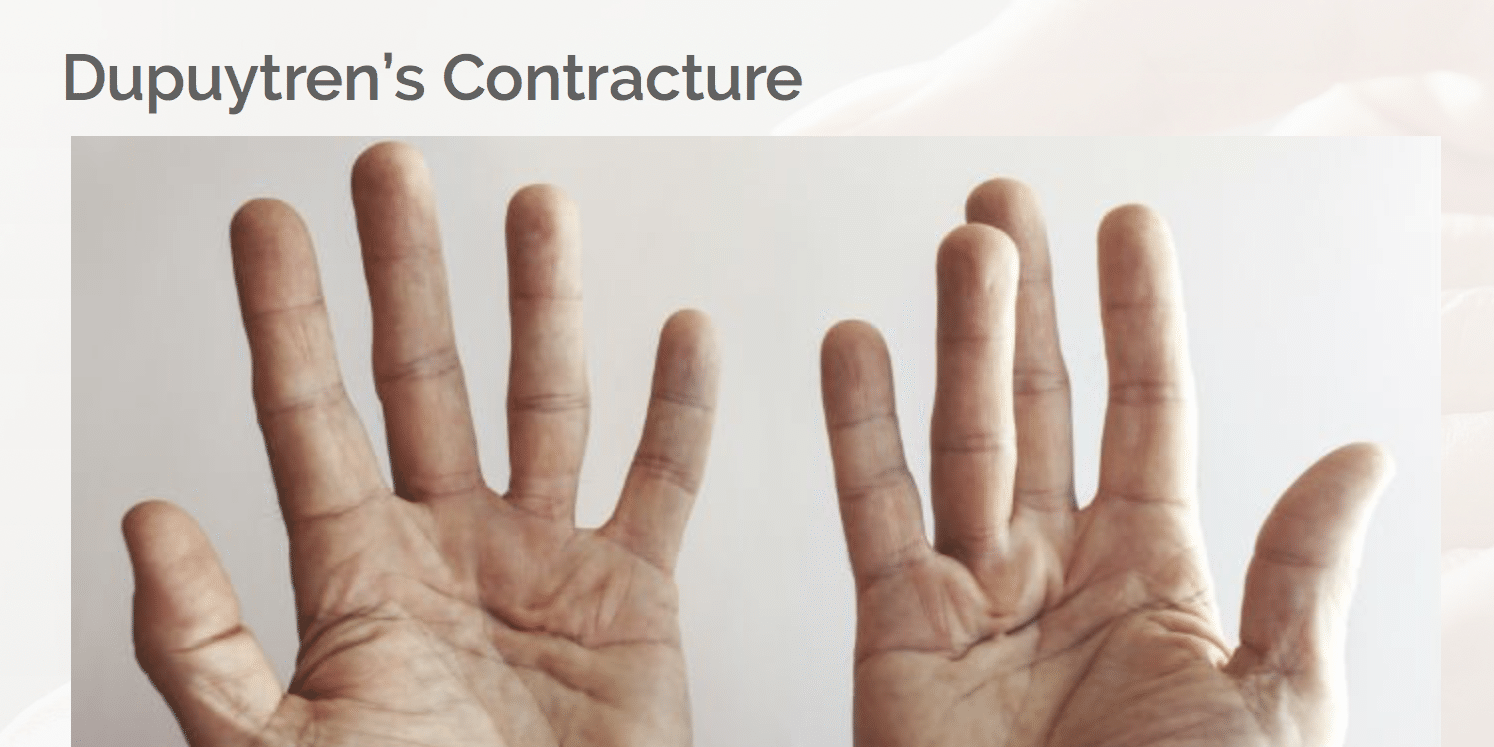 Dupuytren's Contracture