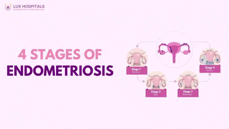 Endometriosis