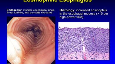 Eosinophilic Esophagitis (EoE)