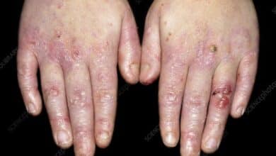 Epidermolysis Bullosa