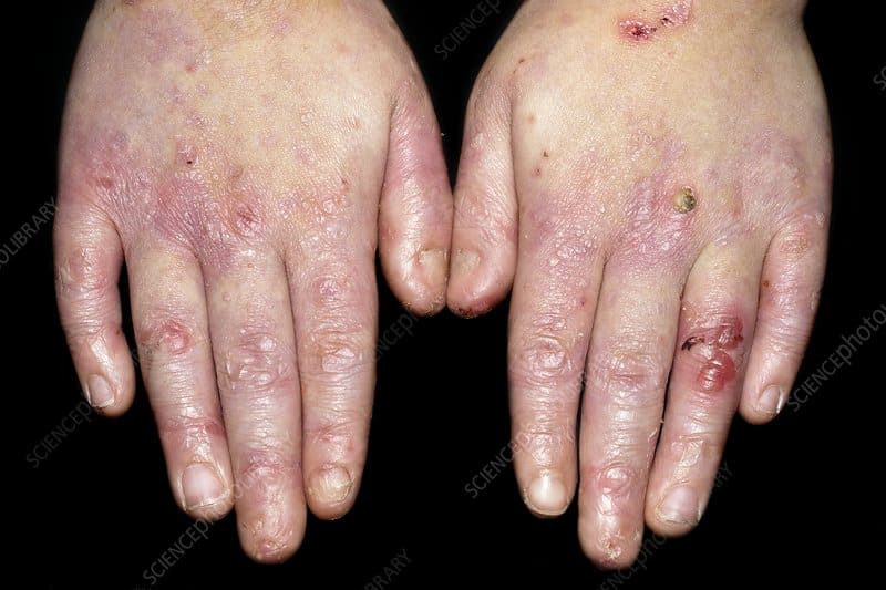 Epidermolysis Bullosa