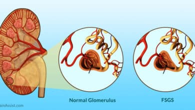 FSGS