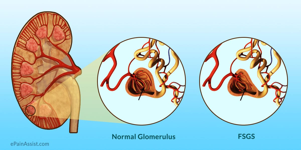 FSGS