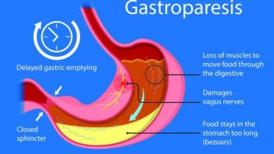Gastroparesis