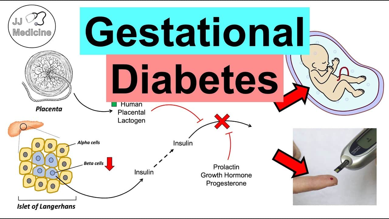 Gestational Diabetes