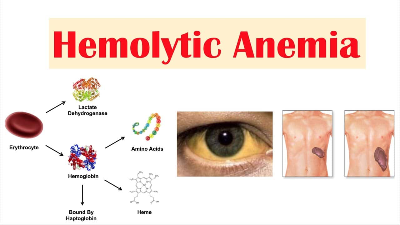 Hereditary Hemolytic Anemia
