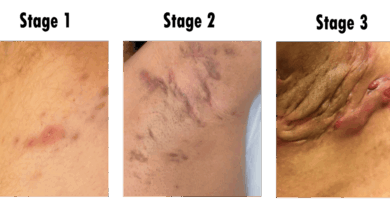 Hidradenitis Suppurativa