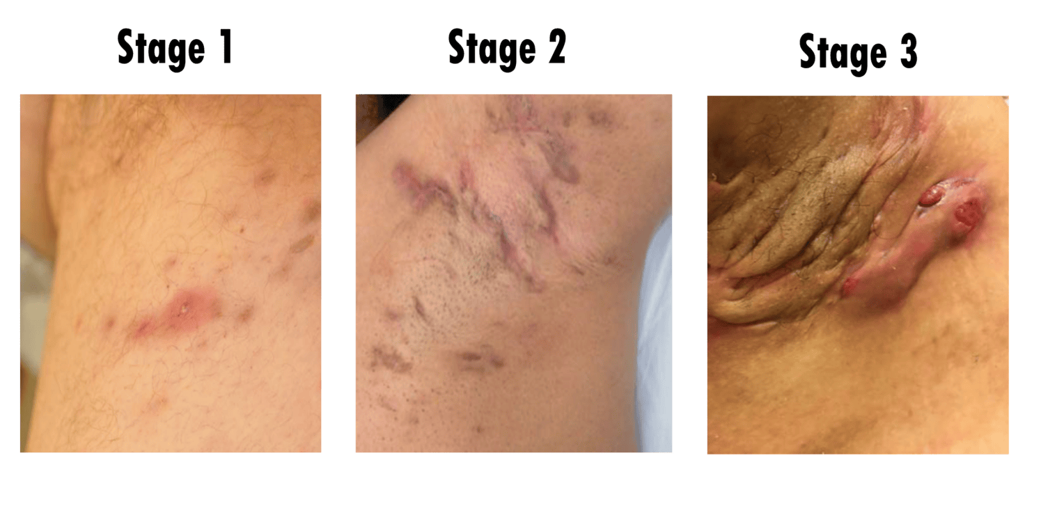 Hidradenitis Suppurativa
