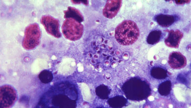 Histoplasmosis