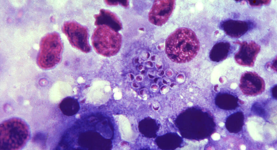 Histoplasmosis