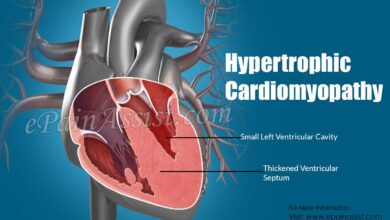 Hypertrophic Cardiomyopathy