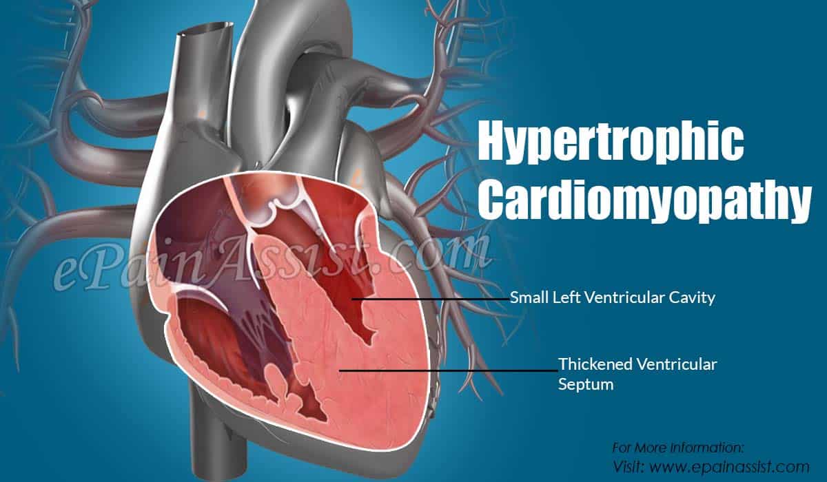 Hypertrophic Cardiomyopathy