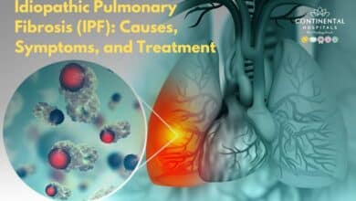 Idiopathic Pulmonary Fibrosis