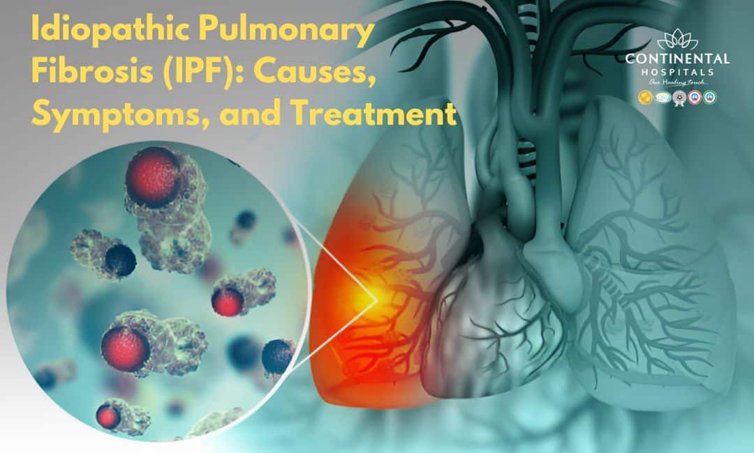 Idiopathic Pulmonary Fibrosis