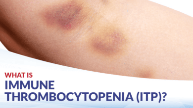 Idiopathic Thrombocytopenic Purpura