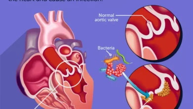 Infective Endocarditis