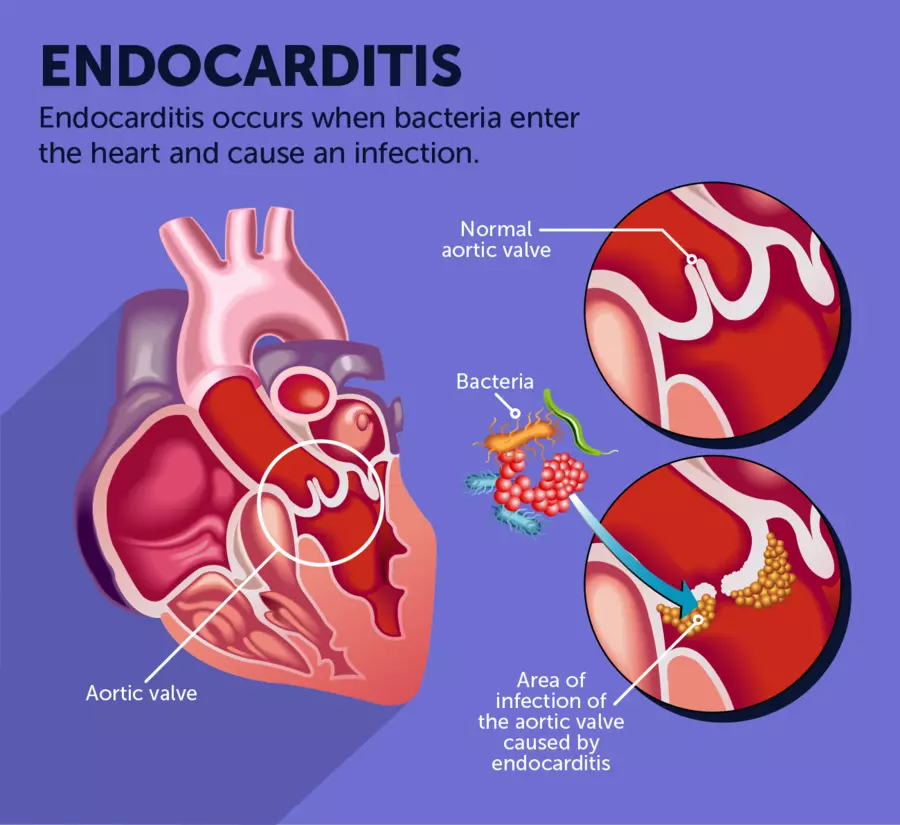 Infective Endocarditis