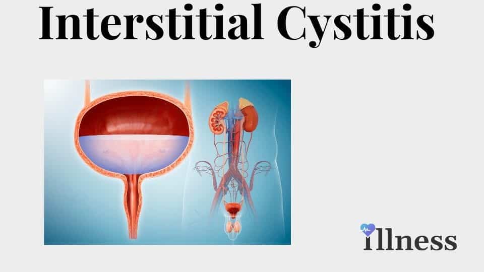 Interstitial Cystitis