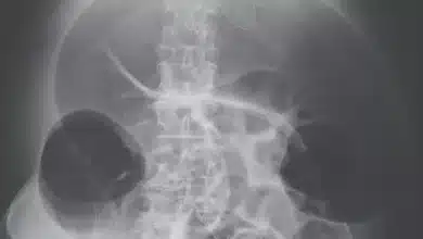 Intestinal Pseudo-Obstruction Ogilvie Syndrome: