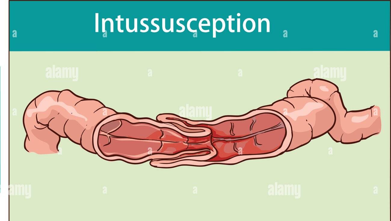Intussusception