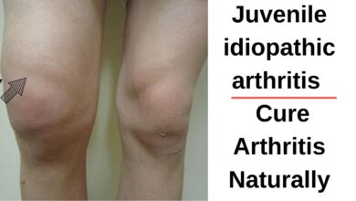 Juvenile Idiopathic Arthritis