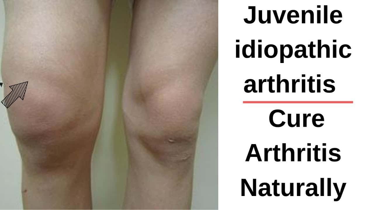 Juvenile Idiopathic Arthritis