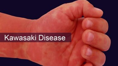Kawasaki Disease