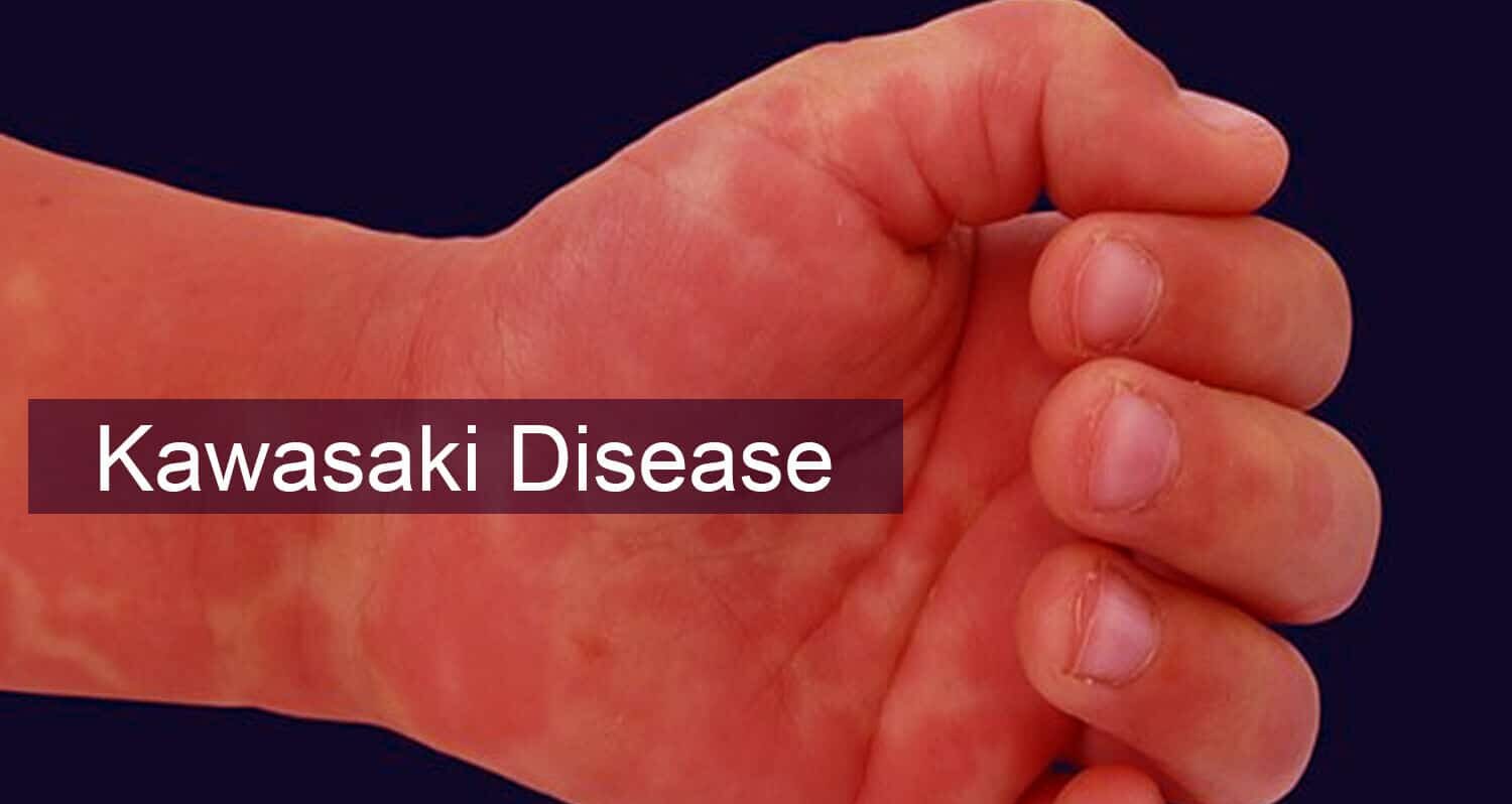 Kawasaki Disease