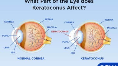 Keratoconus