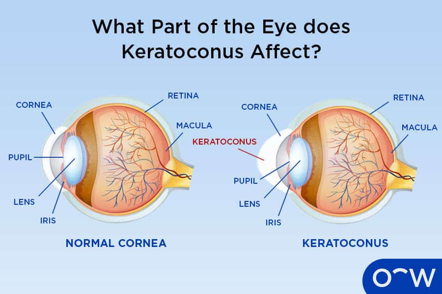 Keratoconus