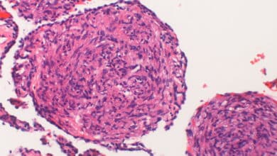 LAM (Lymphangioleiomyomatosis)