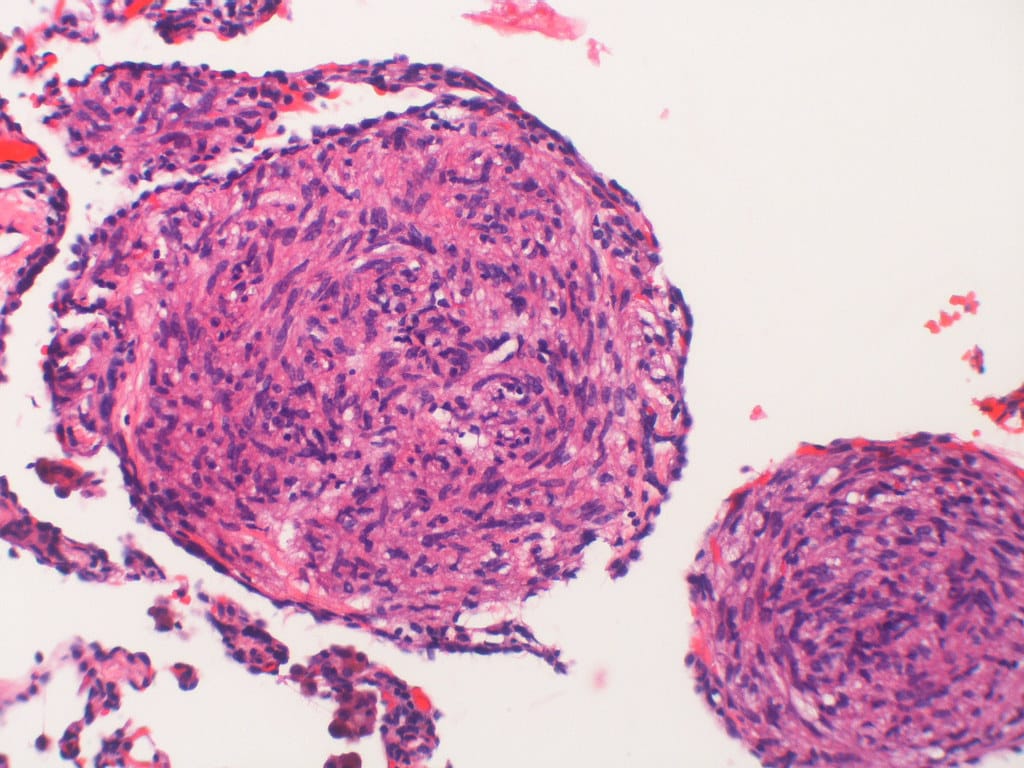 LAM (Lymphangioleiomyomatosis)