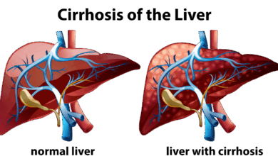 Liver Cirrhosis
