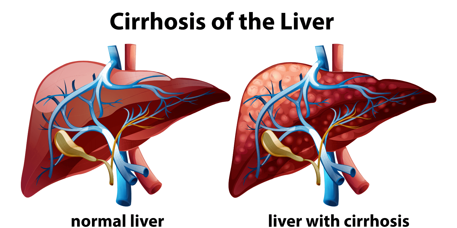 Liver Cirrhosis