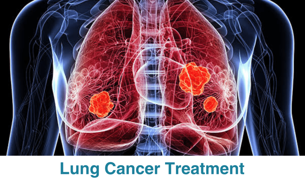Lung Cancer