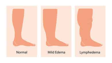Lymphedema