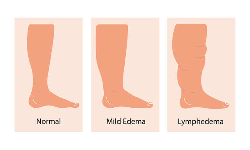Lymphedema