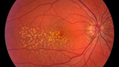 Macular Degeneration