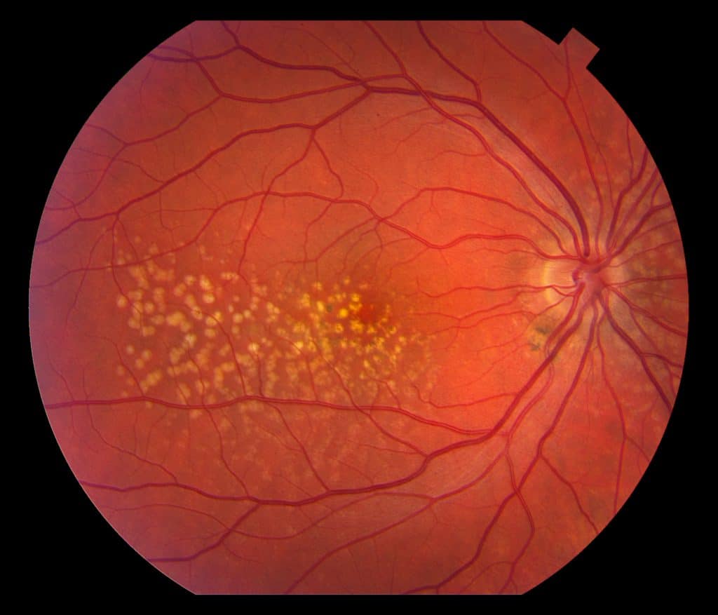 Macular Degeneration