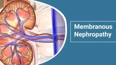 Membranous Nephropathy