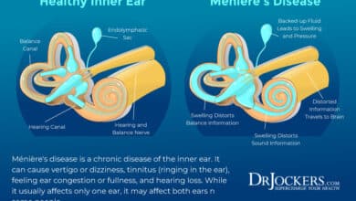 Meniere's Disease