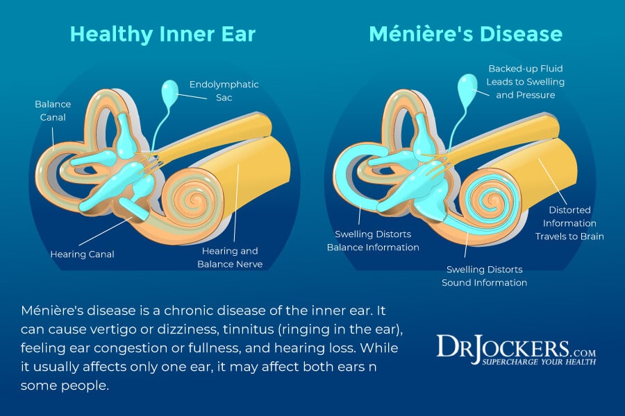 Meniere's Disease