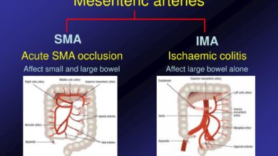 Mesenteric Ischemia