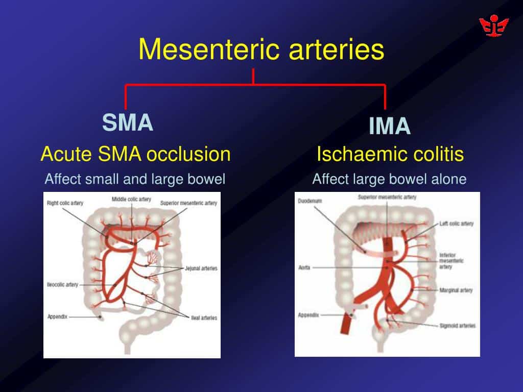 Mesenteric Ischemia