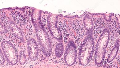 Microscopic Colitis