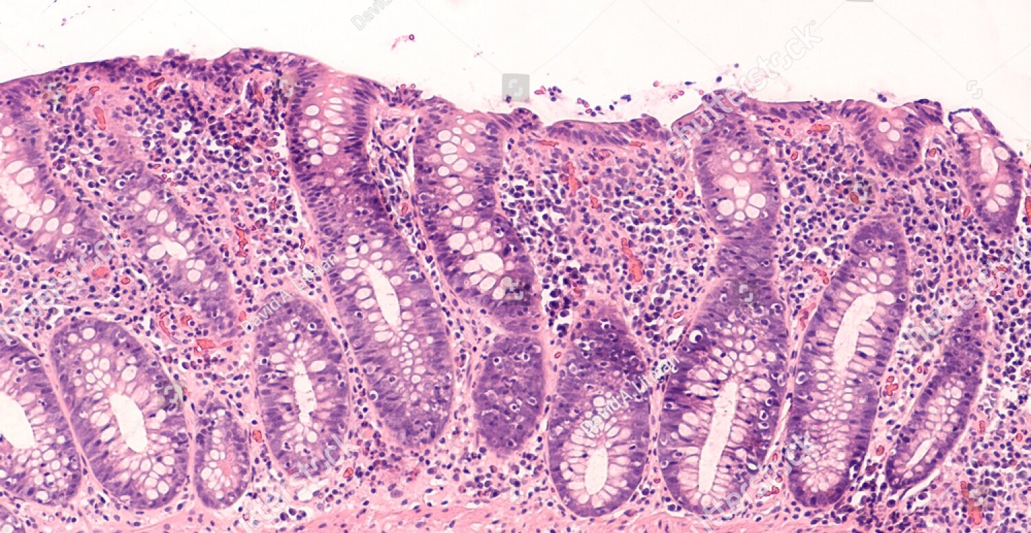 Microscopic Colitis: What It Is and How It's Treated - Observer Voice