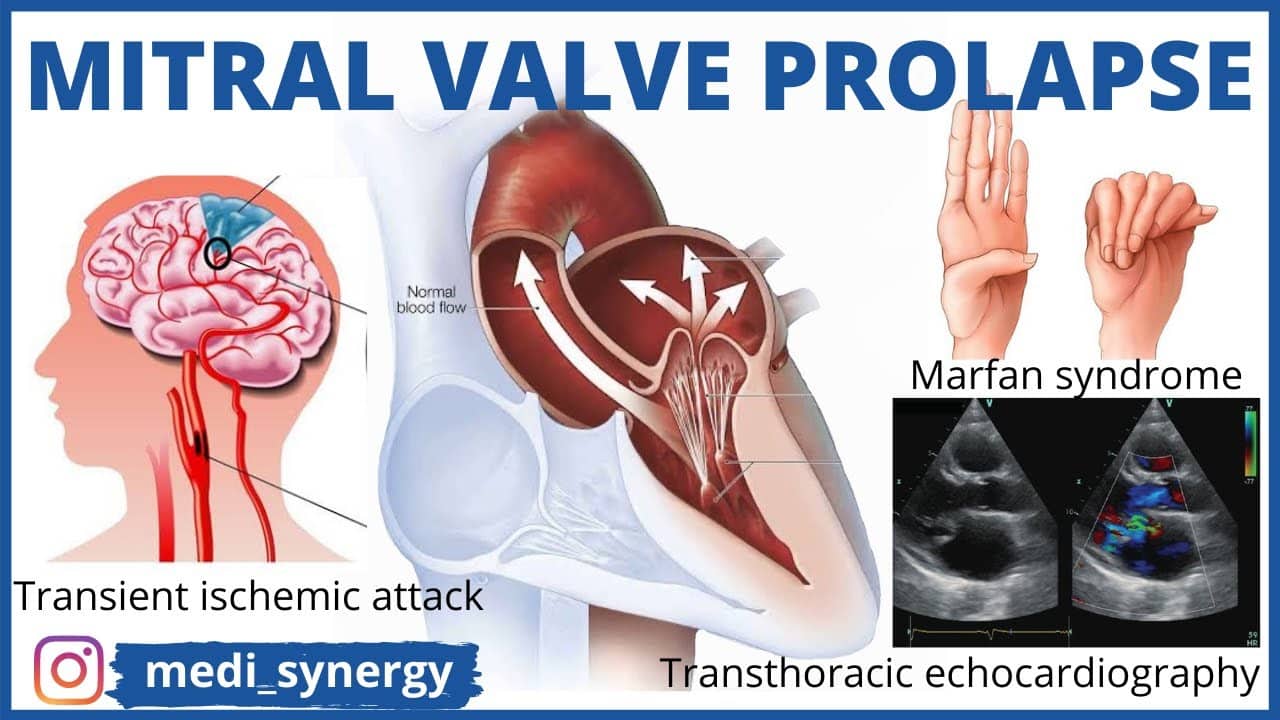 Mitral Valve Prolapse