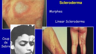 Morphea (Localized Scleroderma)
